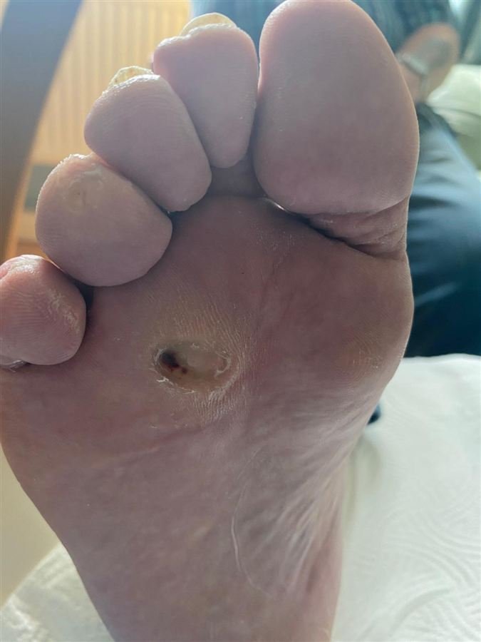 The same area much smaller and smoother after callus removal
