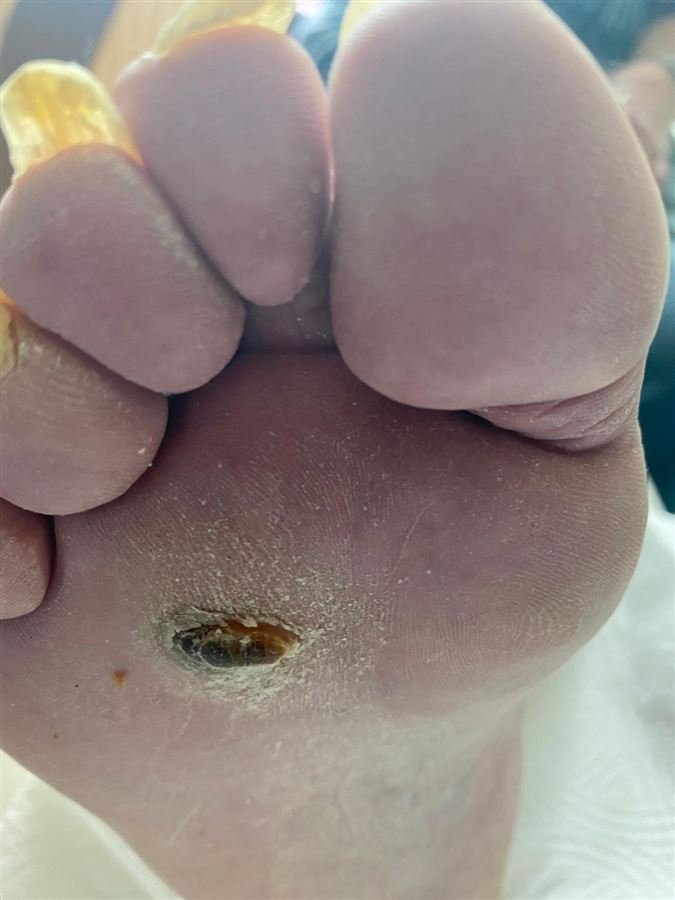 Hard callus with a dark centre on the ball of the foot before treatment