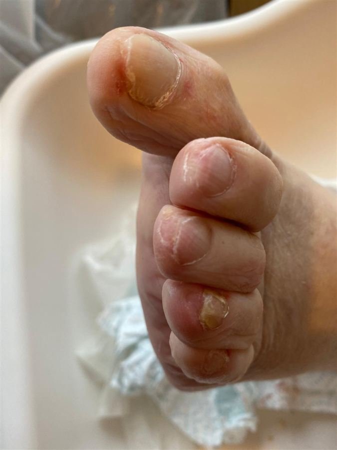 The same toenails cut short and neat after nail care