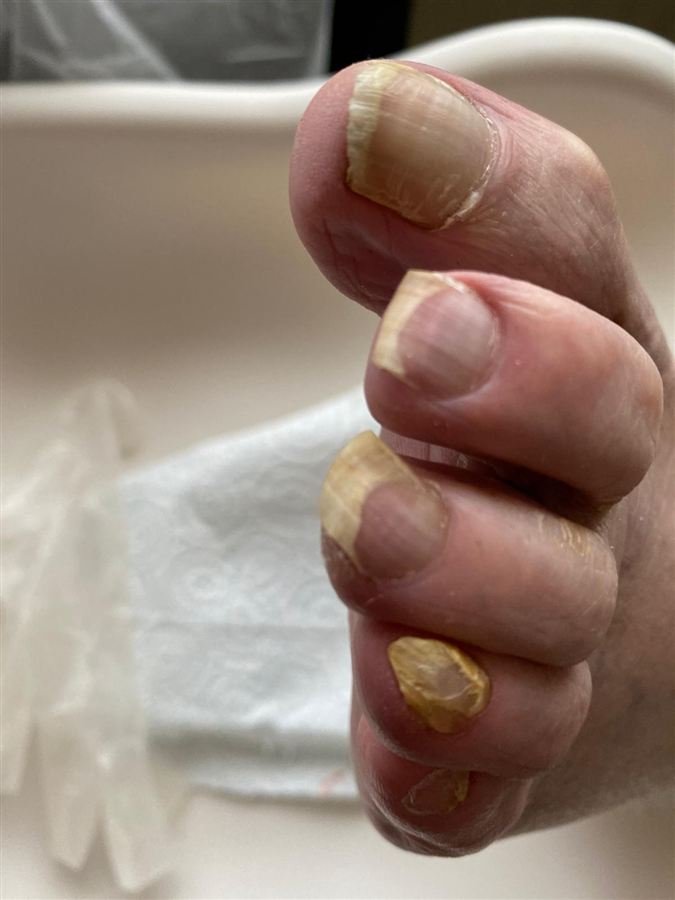 Long, thickened toenails before nail care