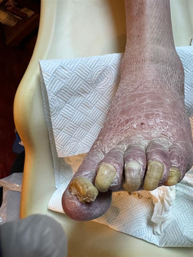 Overgrown, thickened toenails that have become hard to manage