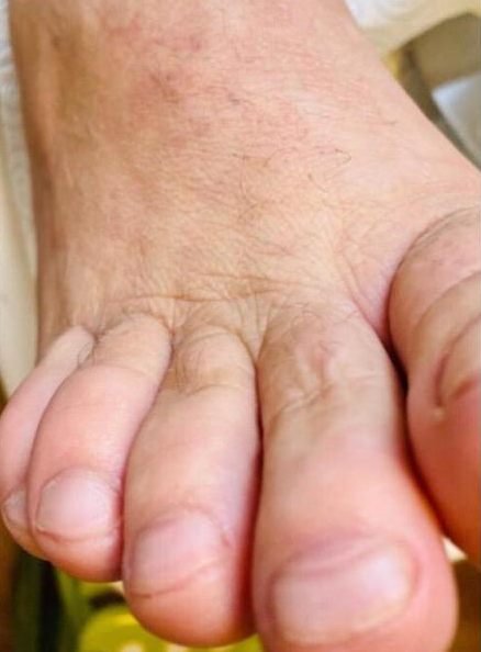 Toes with healthy short nails and smooth skin after treatment